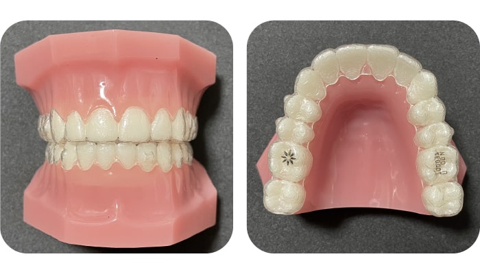 マウスピース型矯正装置（インビザライン）
