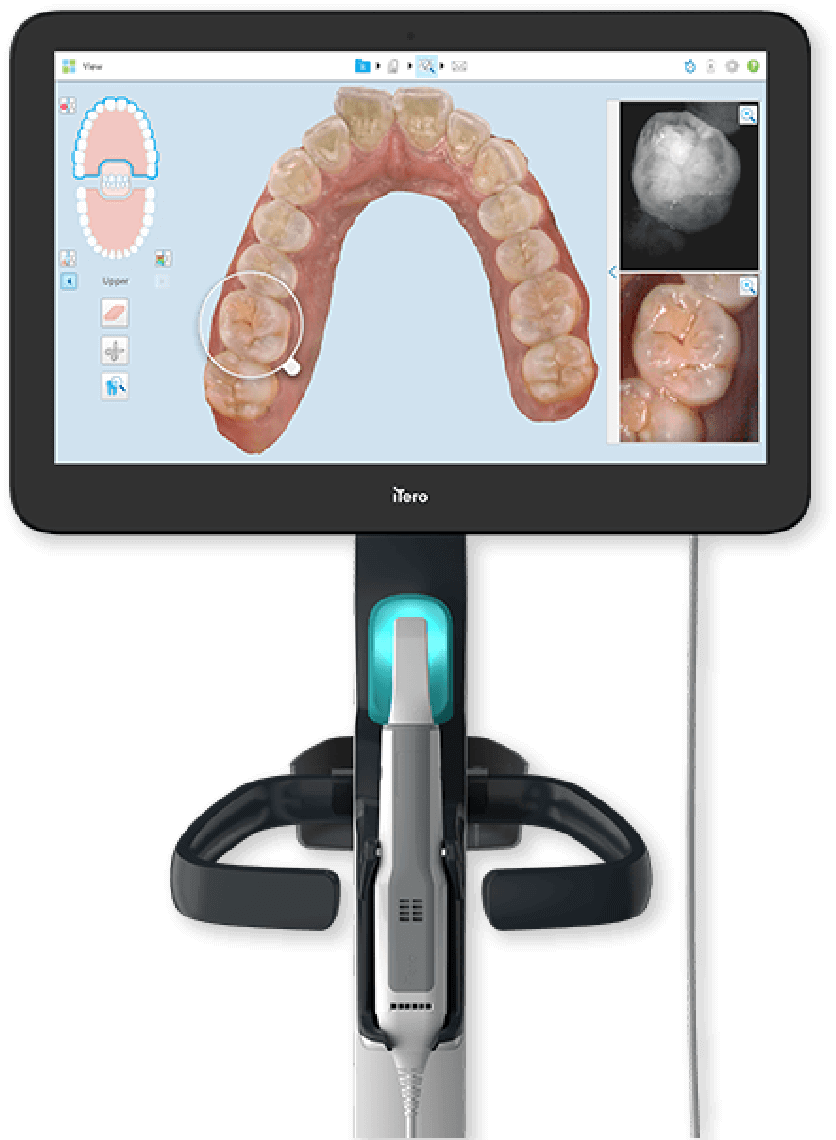 つみき矯正歯科稲毛では、3Dスキャナー「iTero」を用いた治療シミュレーションを行なっています。