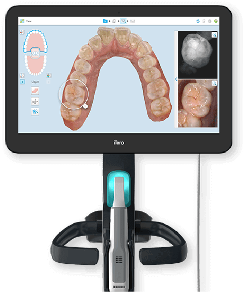 つみき矯正歯科稲毛では、3Dスキャナー「iTero」を用いた治療シミュレーションを行なっています。