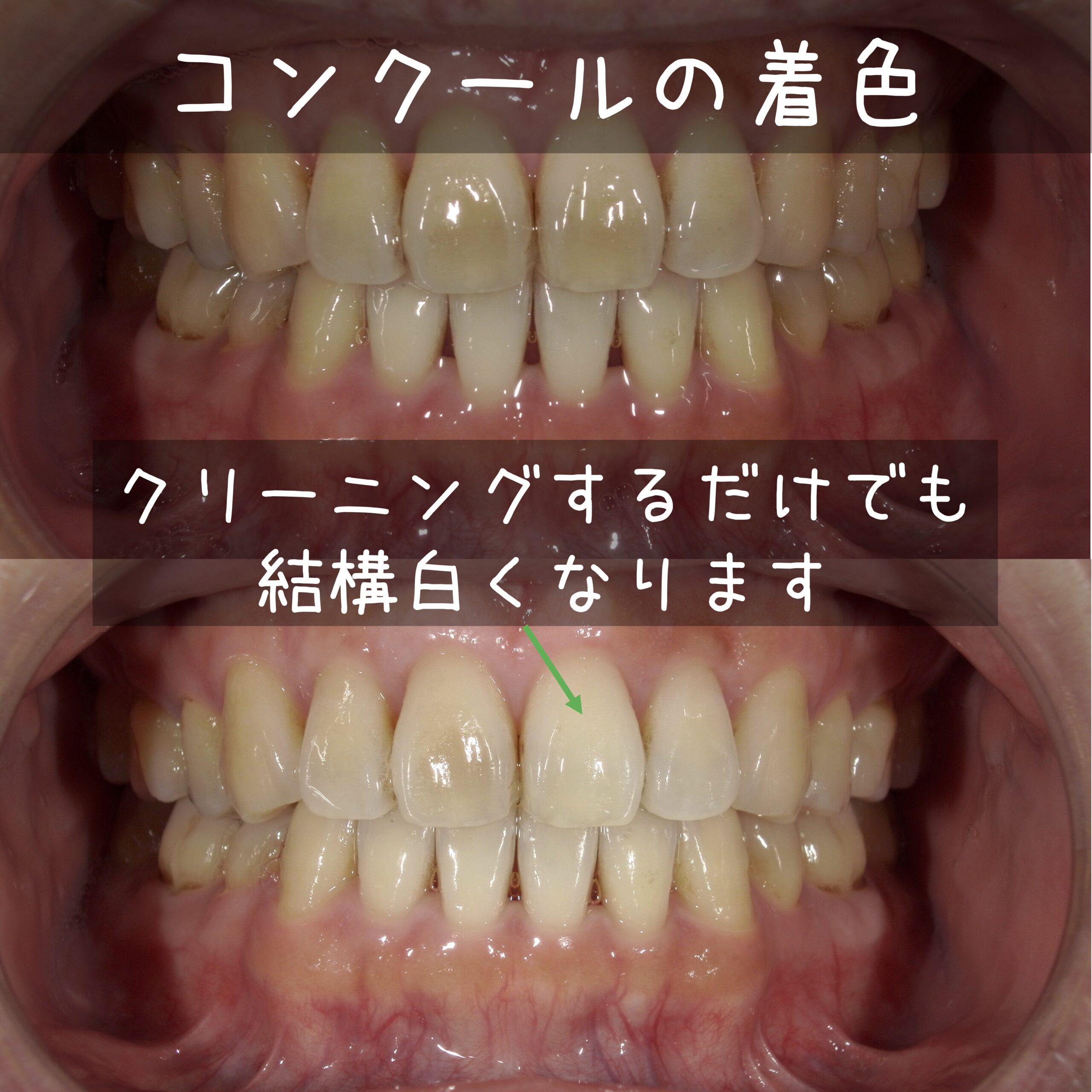 コンクールf 黄ばみ