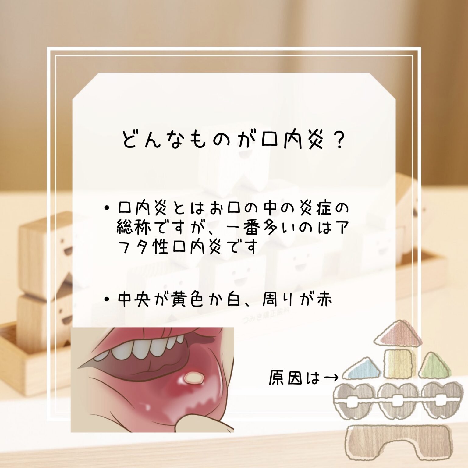 口内炎について | つみき矯正歯科|千葉市稲毛の矯正歯科